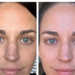 tretinoin before and after