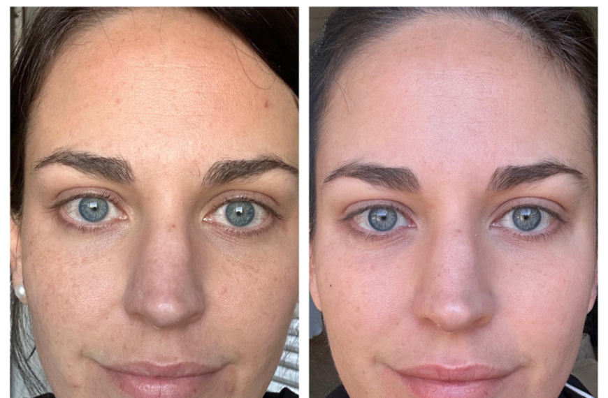 tretinoin before and after