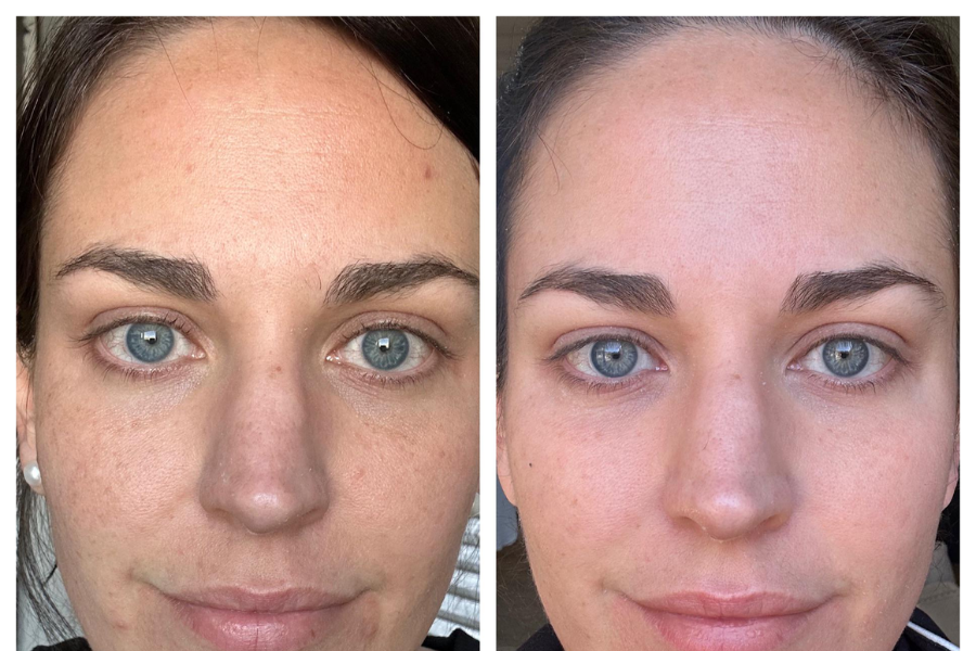 tretinoin before and after